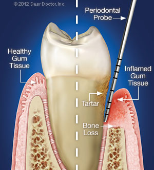 illustration of healthy tooth and tooth infected with gum disease Flint, MI